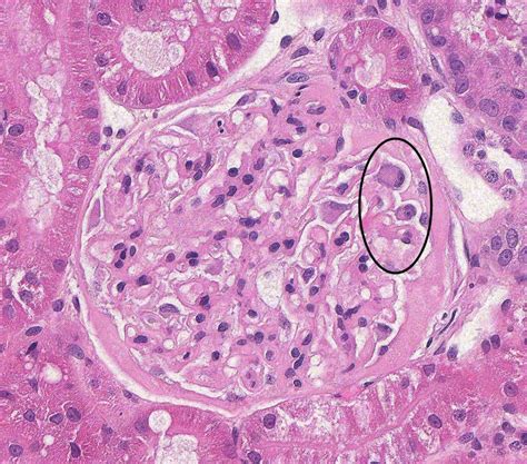 Membranous GN .